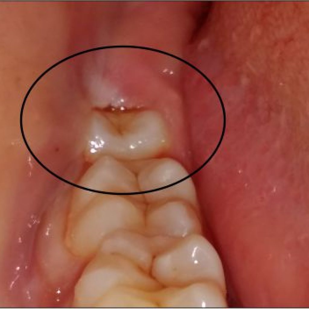 Teeth Whitening in Rajkot: Brighten Your Smile Today Teeth Whitening in Rajkot: Brighten Your Smile Today