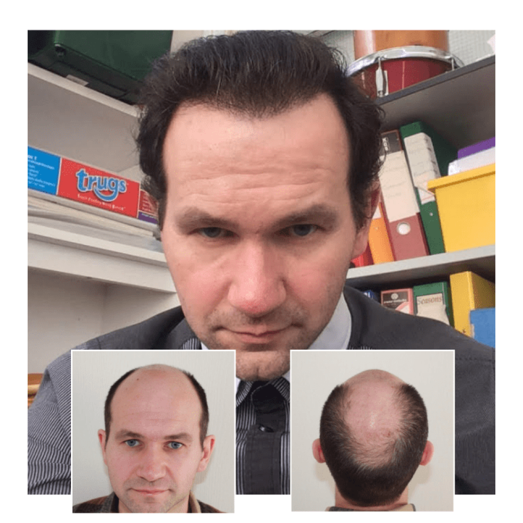 Hair Transplant Kent: Restoring Confidence with Expert Care Hair Transplant Kent: Restoring Confidence with Expert Care