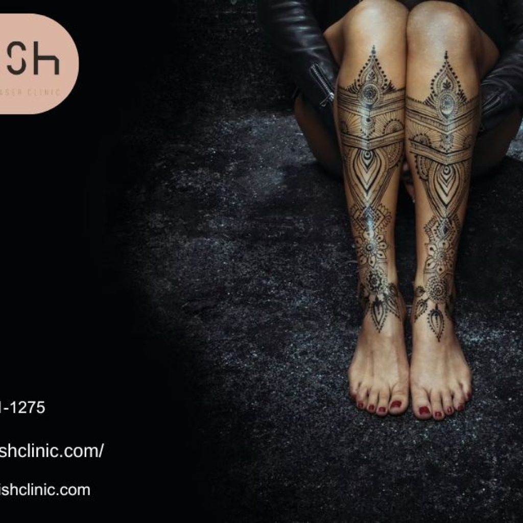 Clear your ink safely with Tattoo laser removal Toronto experts Clear your ink safely with Tattoo laser removal Toronto experts