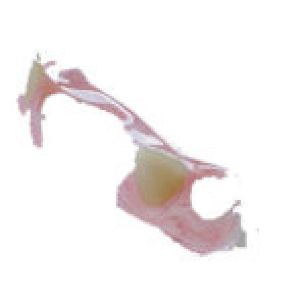 Restore Comfort: Brisbane Dentures Reline Clinic You Can Trust Restore Comfort: Brisbane Dentures Reline Clinic You Can Trust